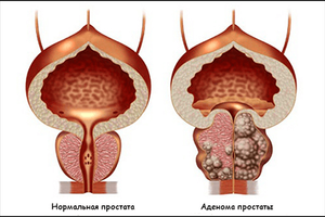 Prostate adenoma: causes, symptoms, treatment and prevention, photo